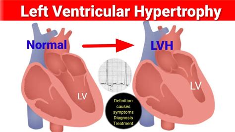 living with left ventricular hypertrophy